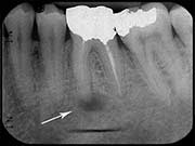 Persistent Abscess