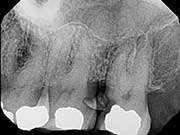 decayed molar