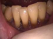 Hopeless Gum Disease