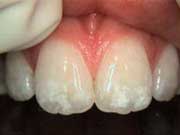 blotchy teeth